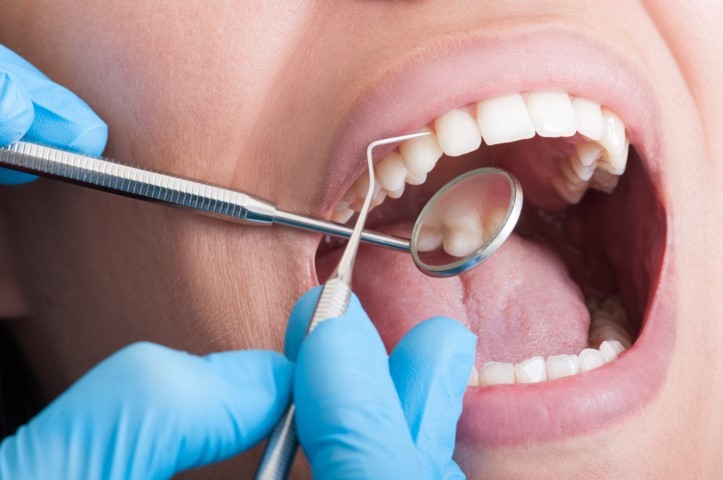 A Cavity: From Birth to Damage