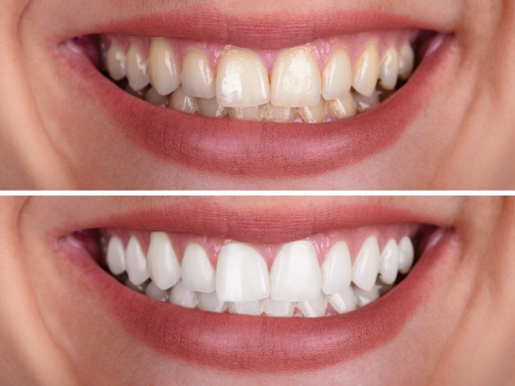 Teeth Whitening: Simple, Safe and Effective